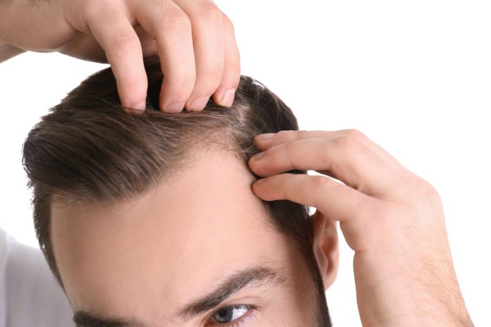 alopecia