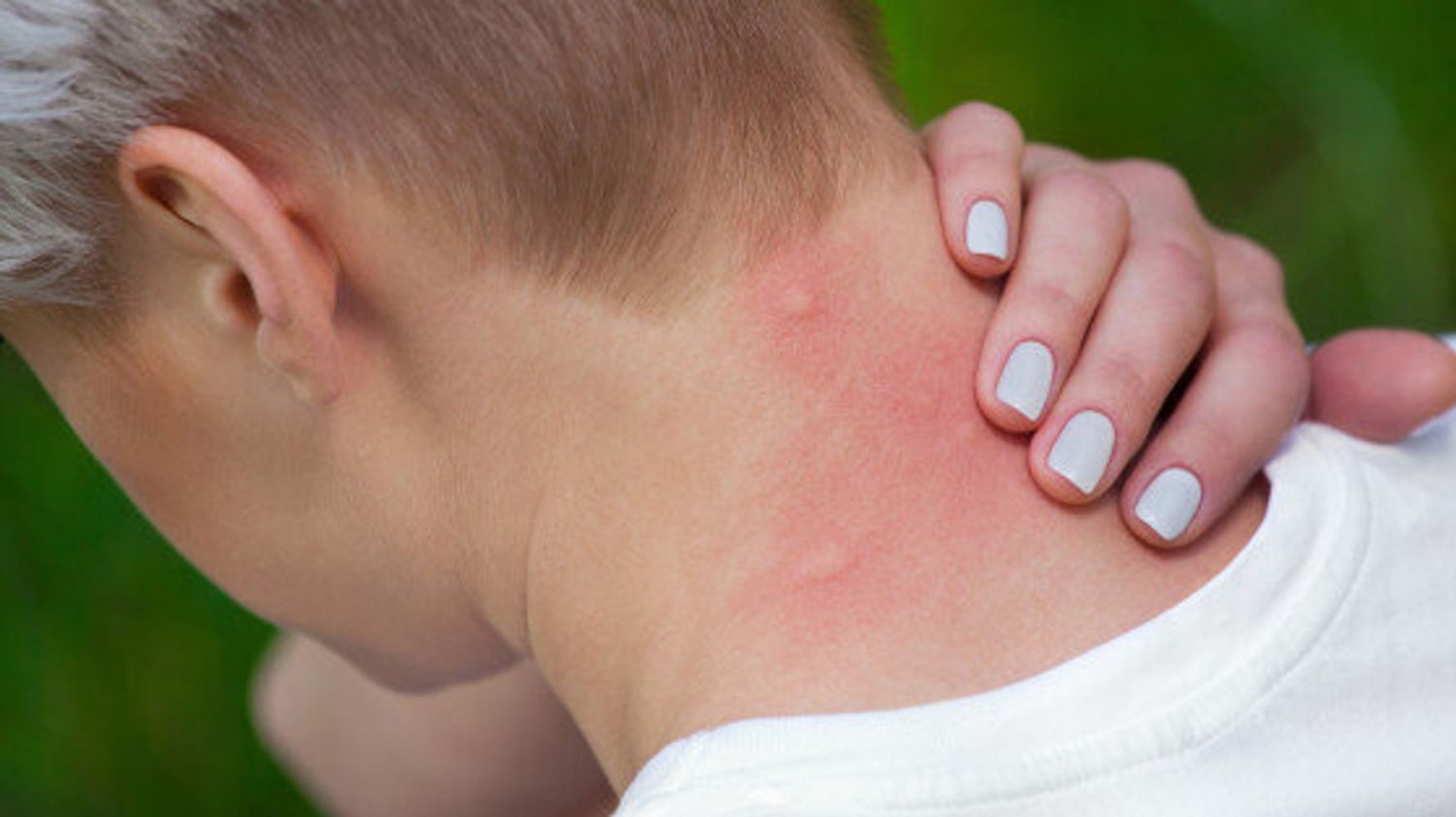 Alerta máxima: Manchas rosas en desagües, señal de posibles problemas de salud. Actúa ahora por tu bienestar 4 Moncloa EFECTOS SOBRE LA PIEL Y LAS ALERGIAS