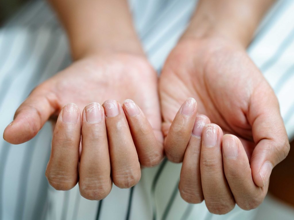 Cómo dejar de morderse las uñas
