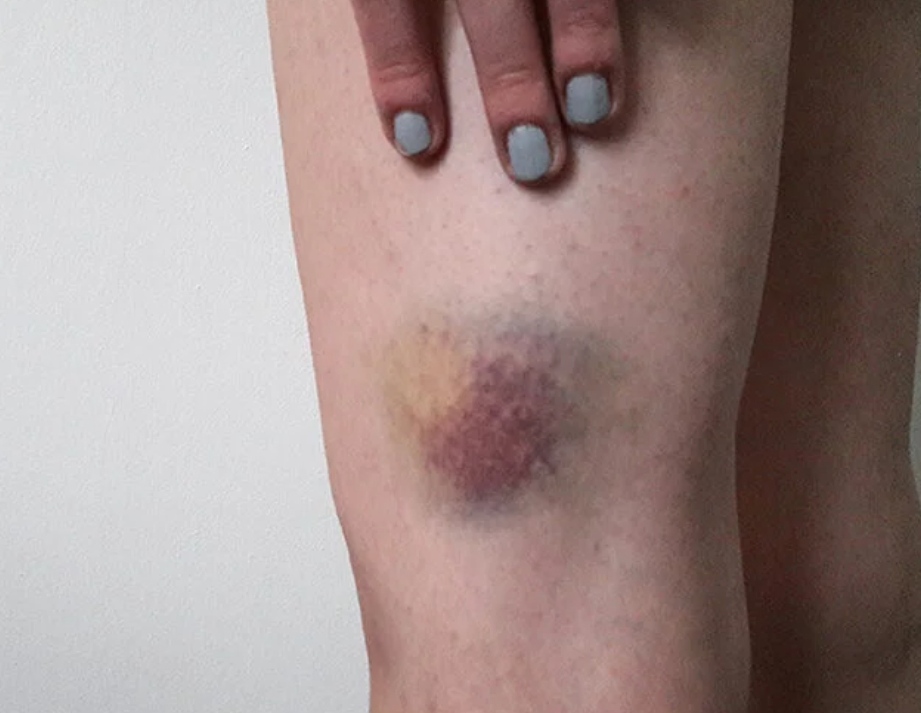 Libera tu piel: 5 soluciones naturales para despedir hematomas fácilmente y sin esfuerzo 1 Moncloa HEMATOMAS: ARNICA, EL REMEDIO NATURAL POR EXCELENCIA