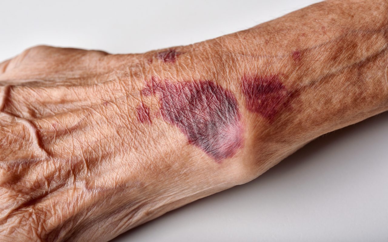 Libera tu piel: 5 soluciones naturales para despedir hematomas fácilmente y sin esfuerzo 5 Moncloa LOS RIESGOS DE AUTOTRATAMIENTO EXCESIVO