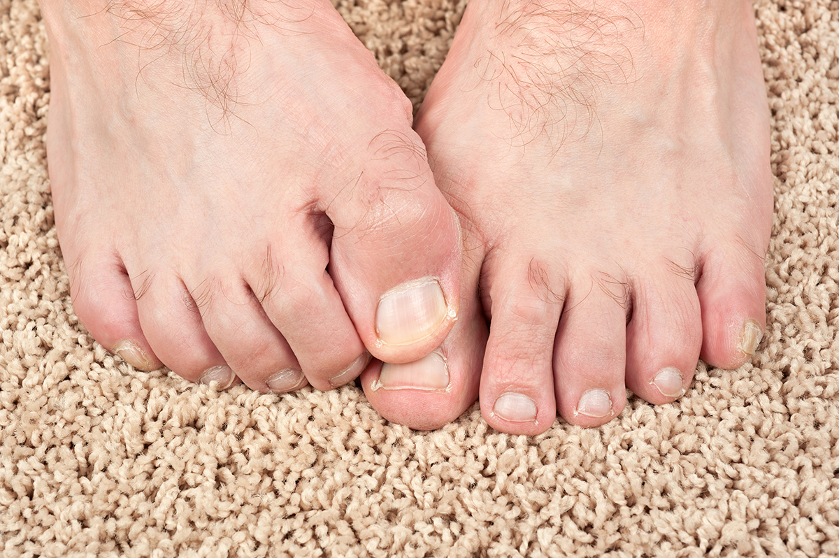 Libérate de los hongos en los pies con estos efectivos y sorprendentes remedios caseros, ¡pruébalos ahora mismo! 3 Moncloa UNA MIRADA CIENTÍFICA A LOS REMEDIOS CASEROS