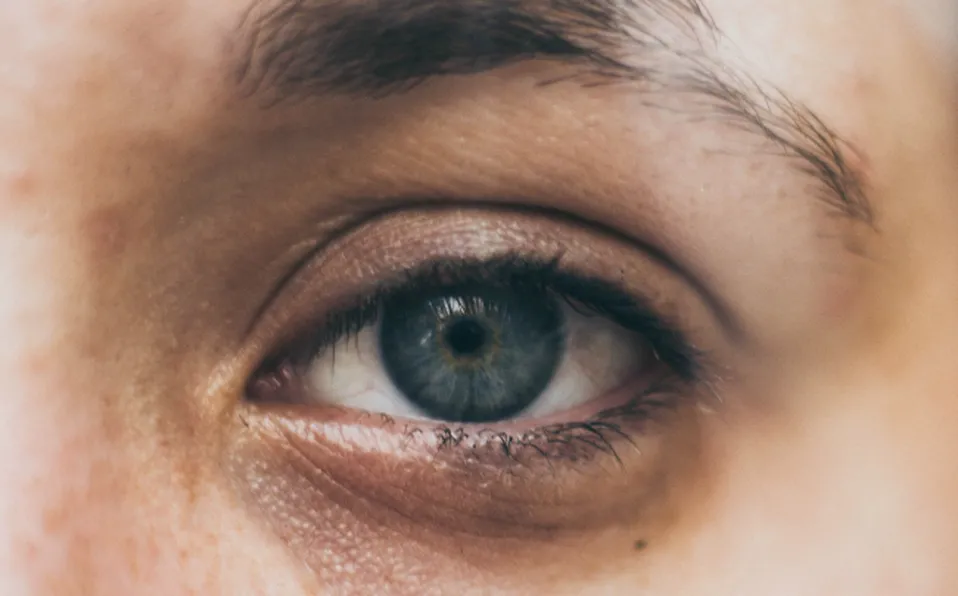 ojeras