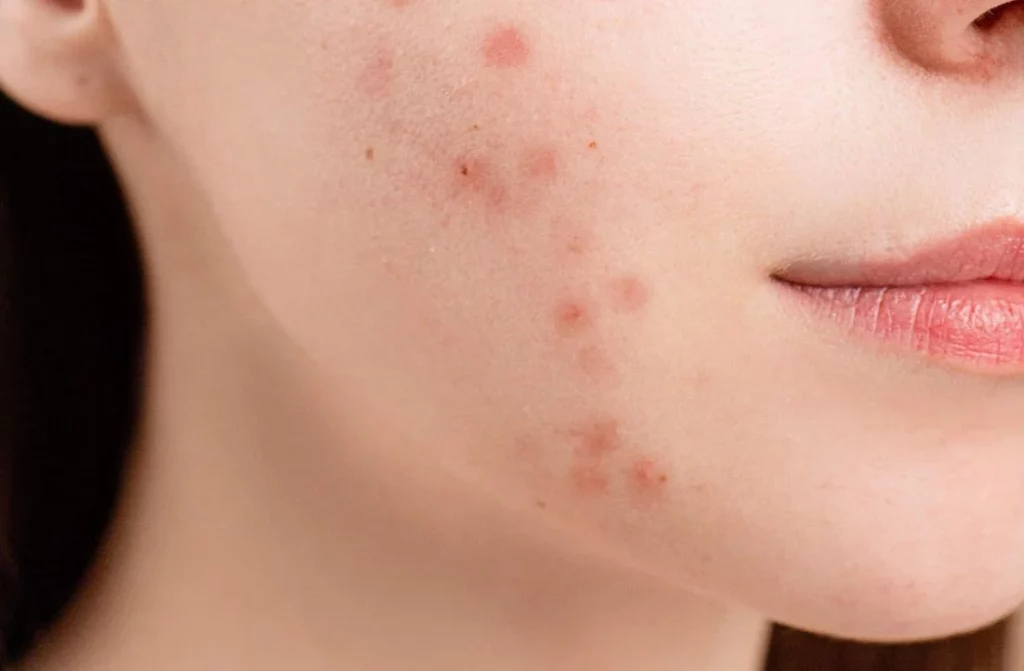 Este es el error más común que produce acné 