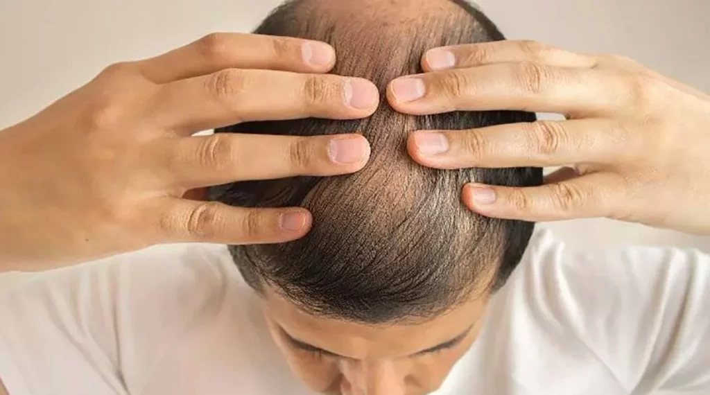 Cómo tomar la biotina para evitar la caída del pelo