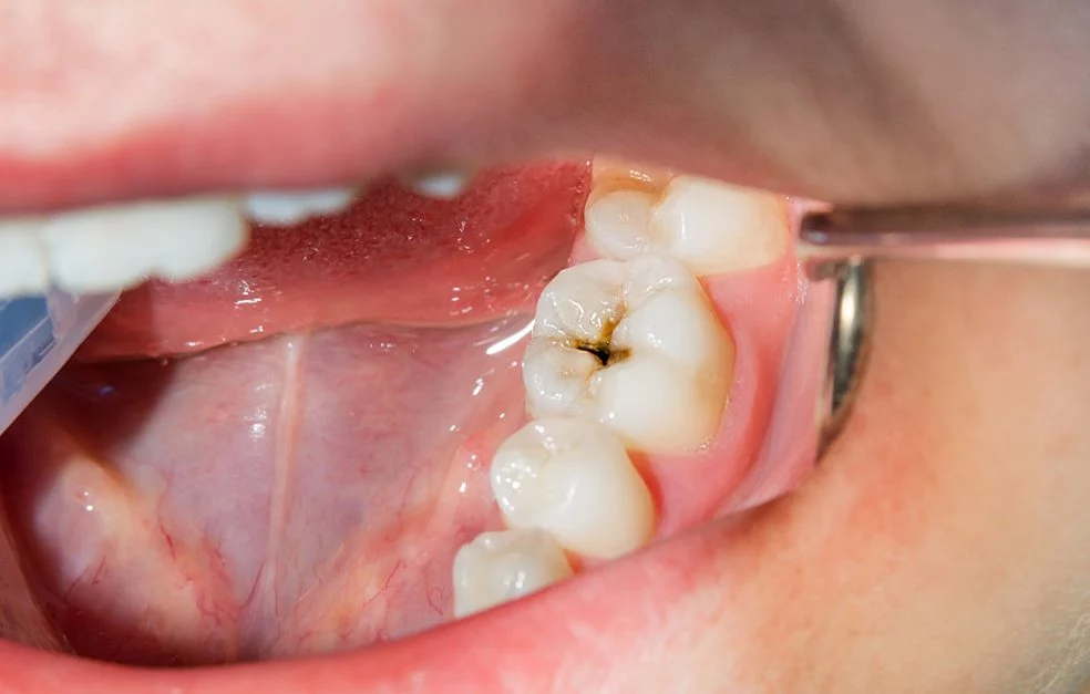 El remedio natural que impide la aparición de caries y mantiene un aliento fresco