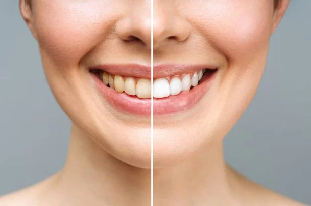 Los riesgos del agua oxigenada para blanquear los dientes: Lo que debes saber