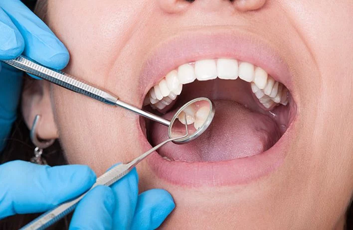 El remedio natural que impide la aparición de caries y mantiene un aliento fresco 2 Moncloa Otras recomendaciones para evitar la caries dental