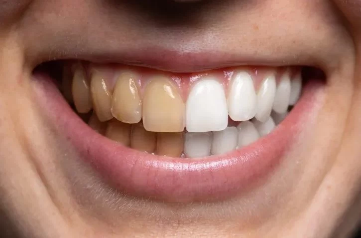 5 alimentos que debes eliminar si quieres unos dientes blancos 1 Moncloa Estos alimentos pueden manchar los dientes
