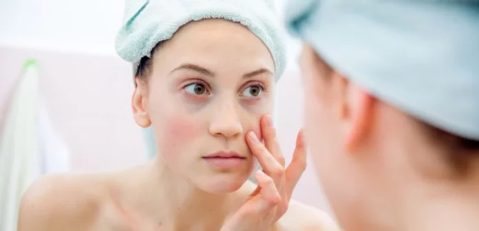 Elimina las bolsas debajo de los ojos de forma natural