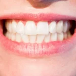 Mitos y leyendas sobre el blanqueamiento dental