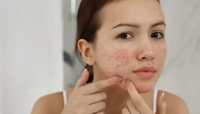 La zona del rostro en la que jamás debes explotar un grano
