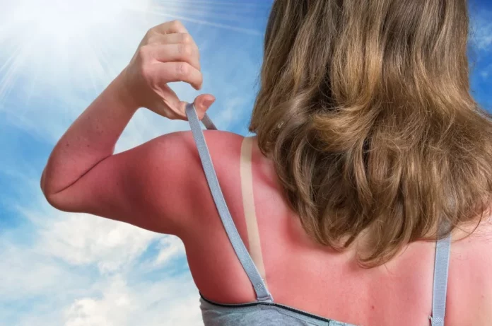 Callo solar: la peligrosa moda de tomar el sol sin protección arrasa en redes