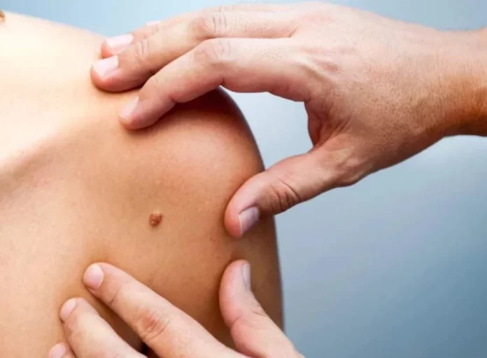 Cáncer de piel: 3 síntomas que pueden pasar desapercibidos que deberías atender