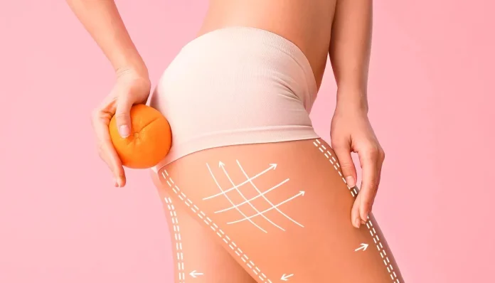 Adiós celulitis: 3 tratamientos caseros que realmente funcionan