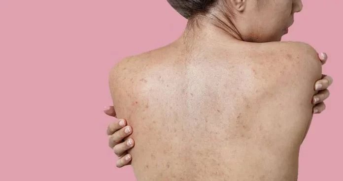 Dile adiós a los granos en la espalda: La guía definitiva para una piel libre de imperfecciones