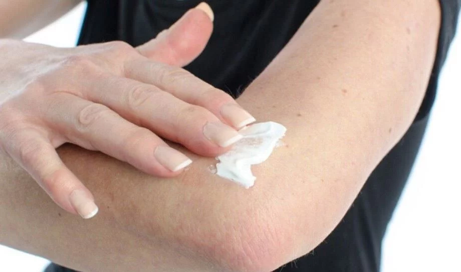 Cura las picaduras de mosquitos con este ingrediente natural que tienes en casa 2 Moncloa Otros consejos para curar la picadura de mosquito