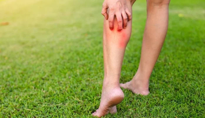 Cura las picaduras de mosquitos con este ingrediente natural que tienes en casa