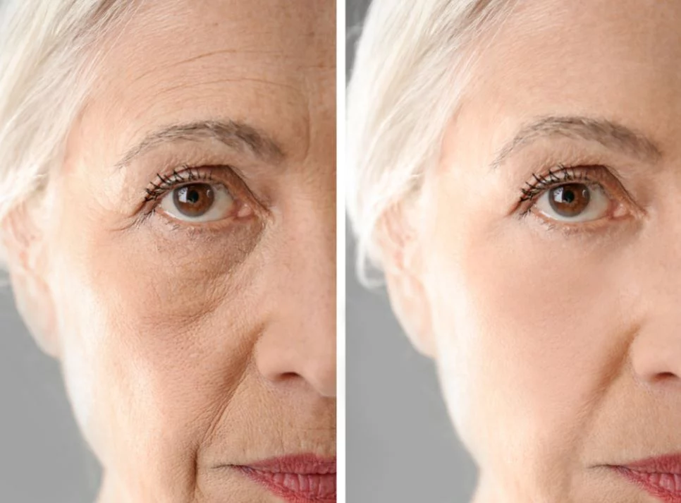 Descubre el lifting facial: qué es y los riesgos que conlleva 2 Moncloa ¿Todos pueden someterse a un lifting facial?
