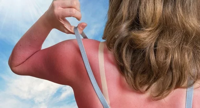 Cura las quemaduras solares con este remedio natural casero