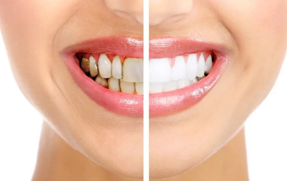 Odontólogos revelan 5 secretos para unos dientes blancos sin sensibilidad que desconocías