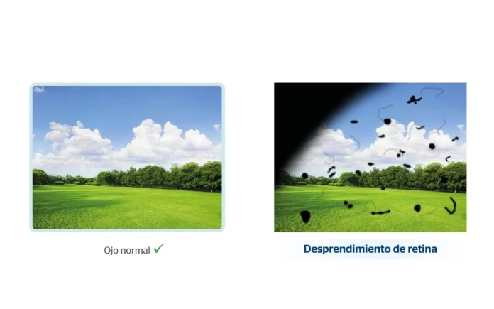 Desprendimiento de retina.