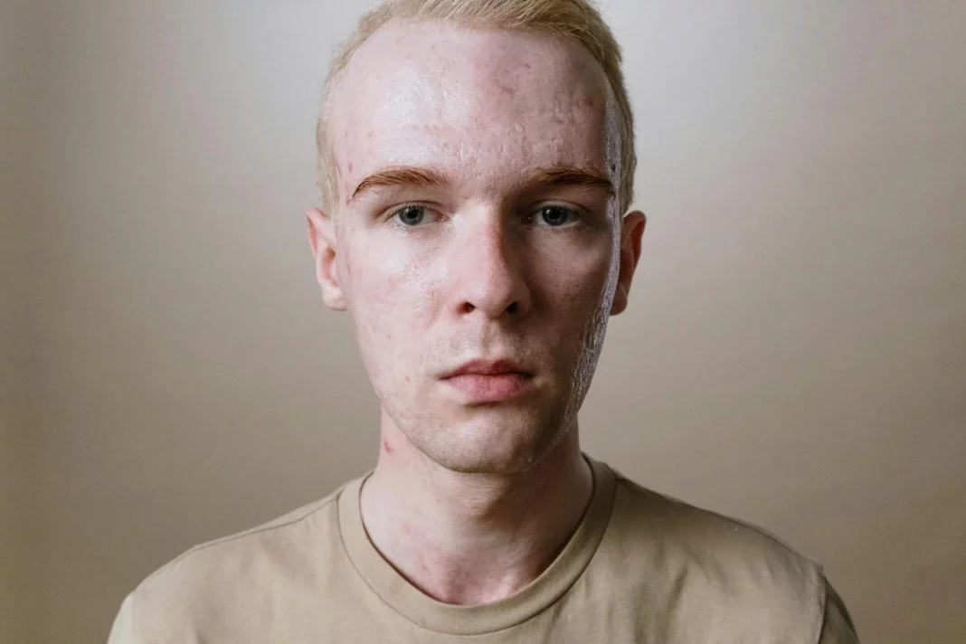 Los problemas que oculta el acne