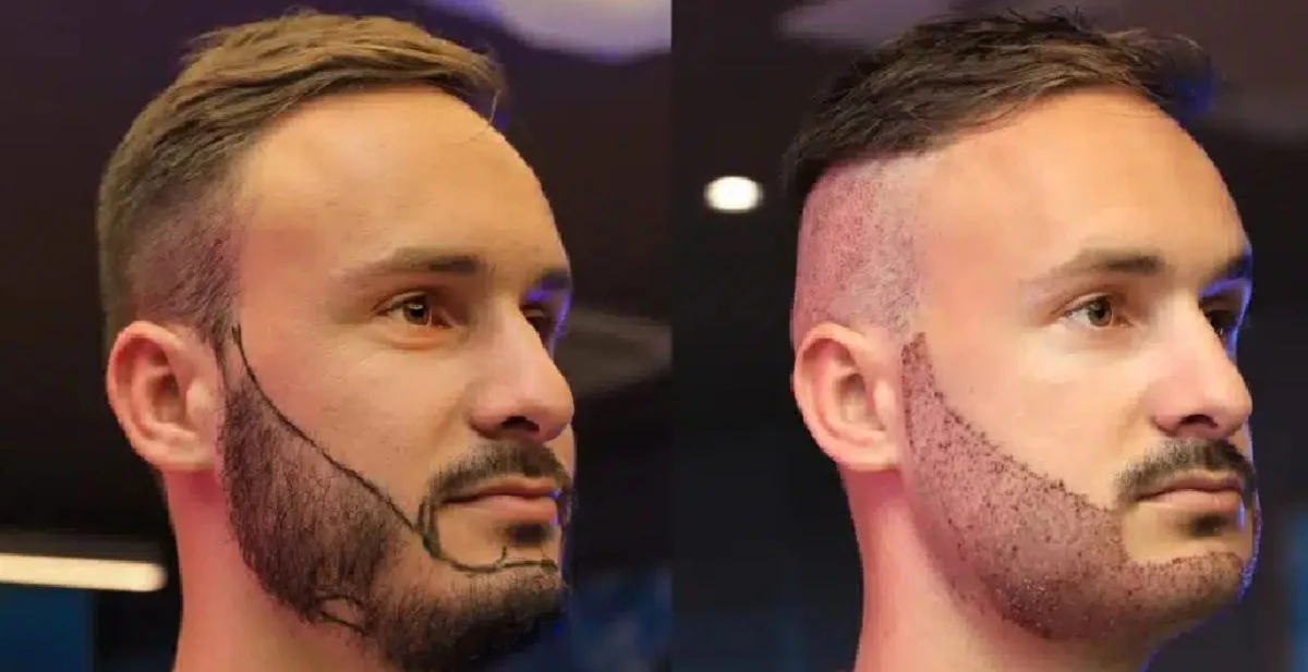 Injerto de barba