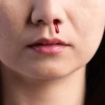 Qué hacer (y qué evitar) cuando sangra la nariz: mitos y verdades que debes conocer